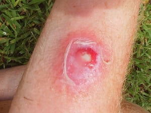 staph infection on forearm