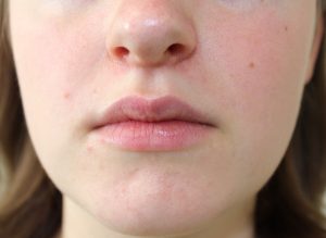 face with rash around nose and mouth