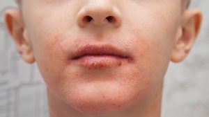 child with red rash around mouth