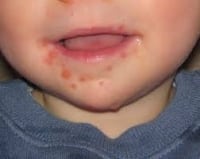 child with Perioral dermatitis on face