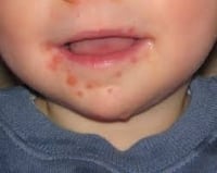 What Is Perioral Dermatitis? Symptoms, Causes, Diagnosis, Treatment, and  Prevention