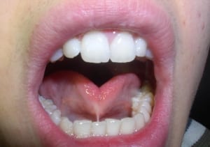 Frenulum_linguae