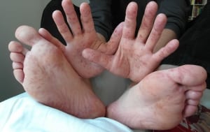 hands and feet of adult experiencing Hand, Foot and Mouth Disease