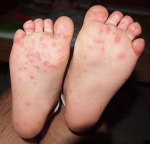 hand, foot and mouth disease on child's feet