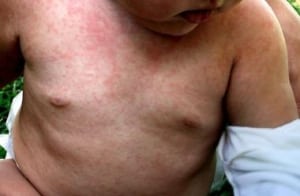 child with roseola rash on chest