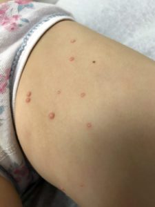 child's arm showing symptoms of molluscum contagiosum