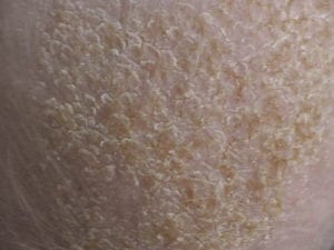 cradle cap