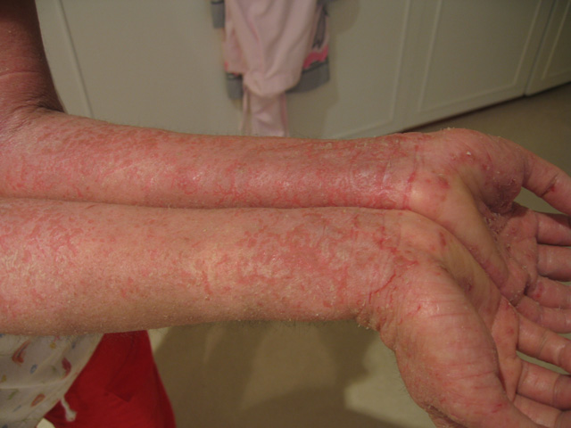Arms with eczema infection