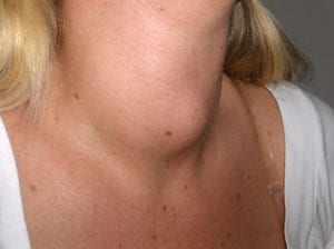 neck swollen with a goiter