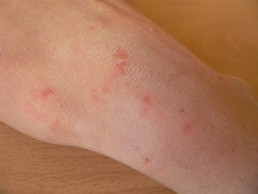 scabies rash on arm