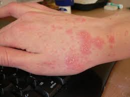 scabies rash