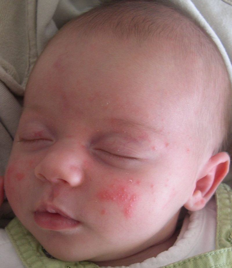 Neonatal Acne Growing Healthy Together Long Beach