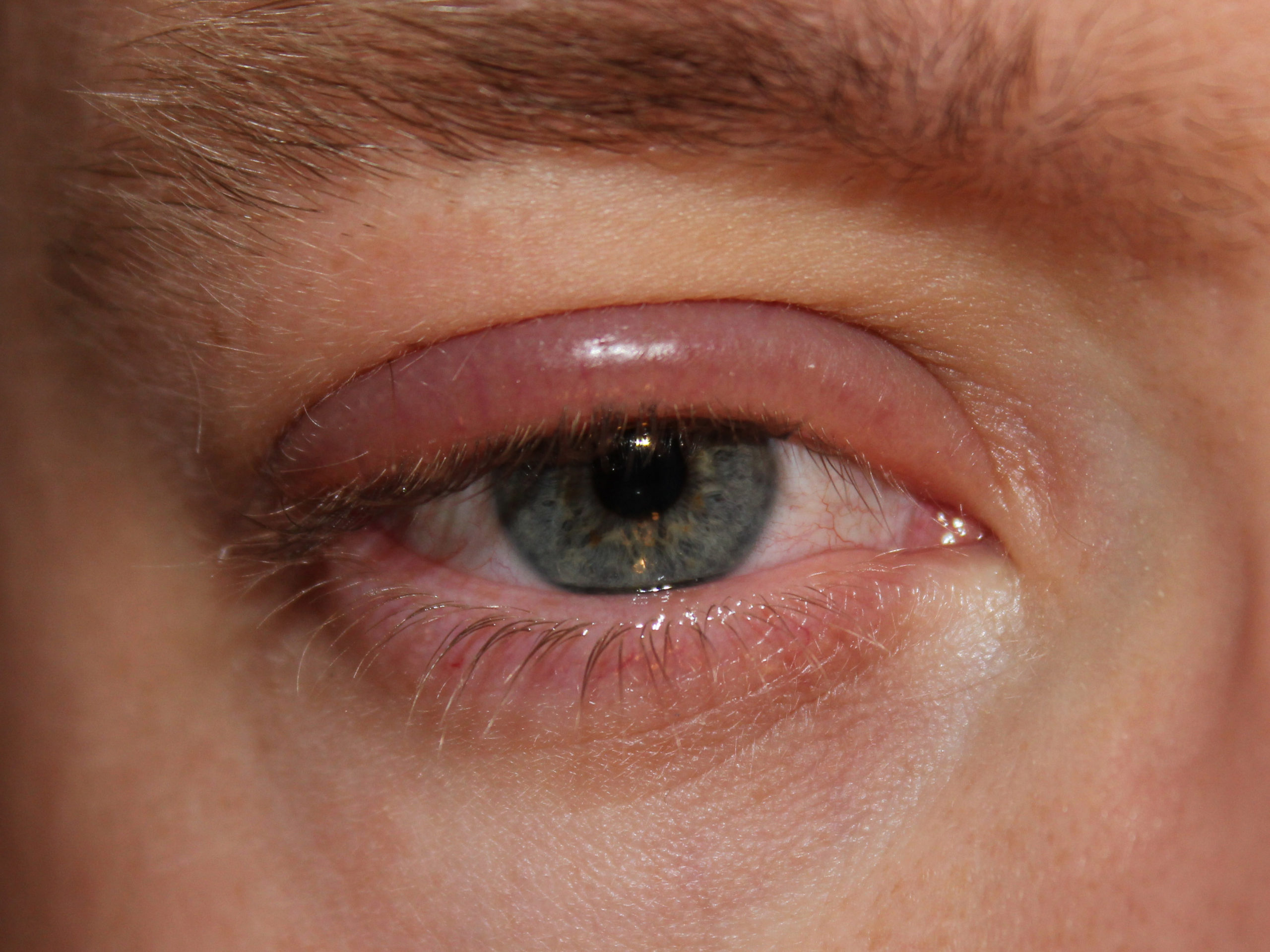 blepharitis - swollen eyelid