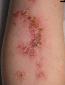 impetigo on child's elbow