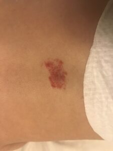 Hemangioma: A baby's bare back with a bright red mark exposed above a white blanket or diaper. The red mark is irregular in size. 