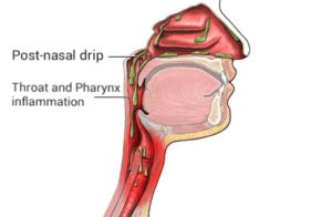 diagram of post-nasal drip